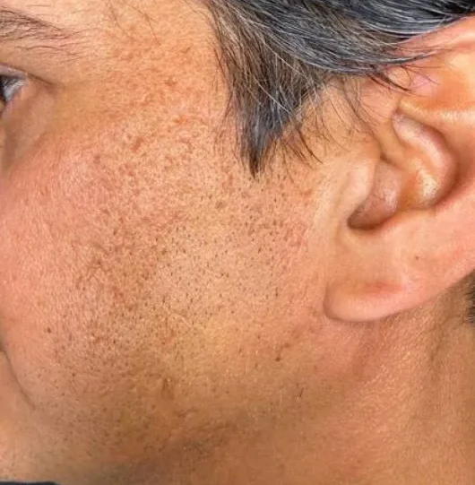 virtue rf microneedling before and after